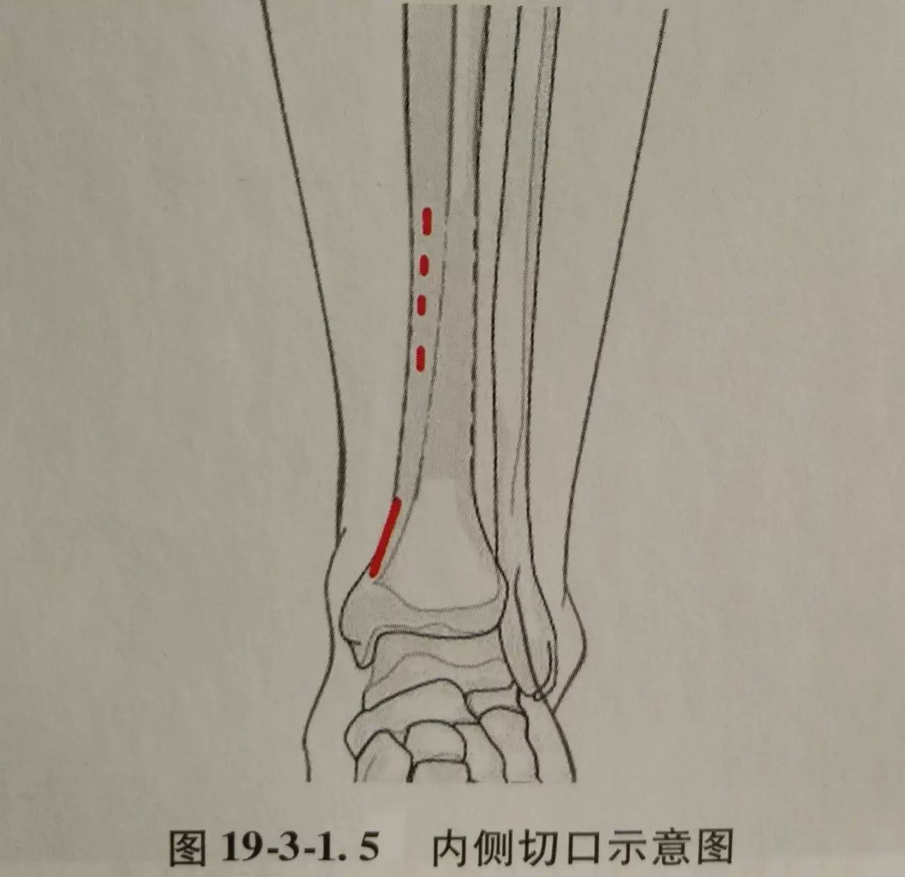 手术详解 | 胫腓骨远端关节内骨折+内踝+后踝骨折——关节面经皮钳夹复位、lcp内固定