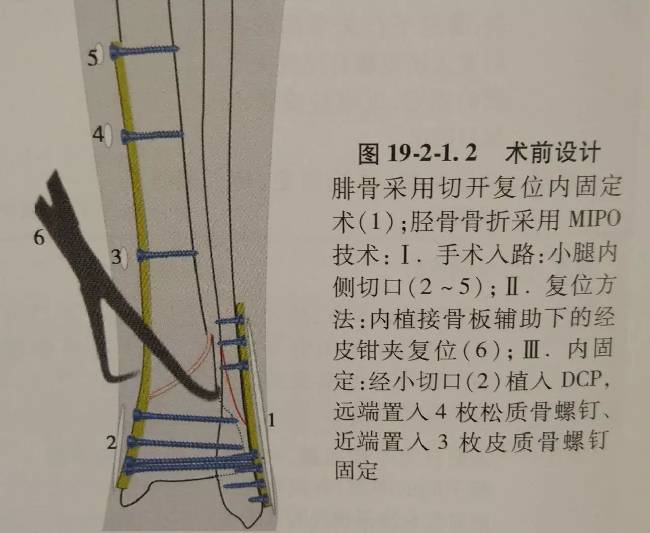 6,手术步骤 (一)手术入路 外踝骨折:于小腿远端外侧面,以骨折为中心