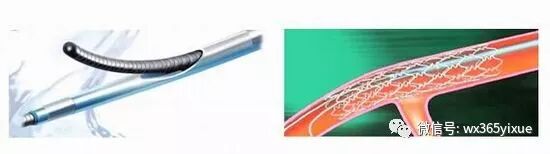 为什么要用到微导管高传玉：微导管的临床应用_https://www.jmylbn.com_新闻资讯_第4张