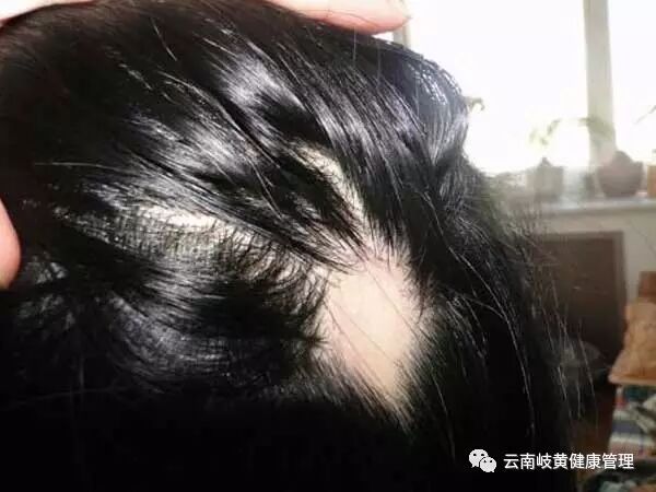 斑秃中医怎么治