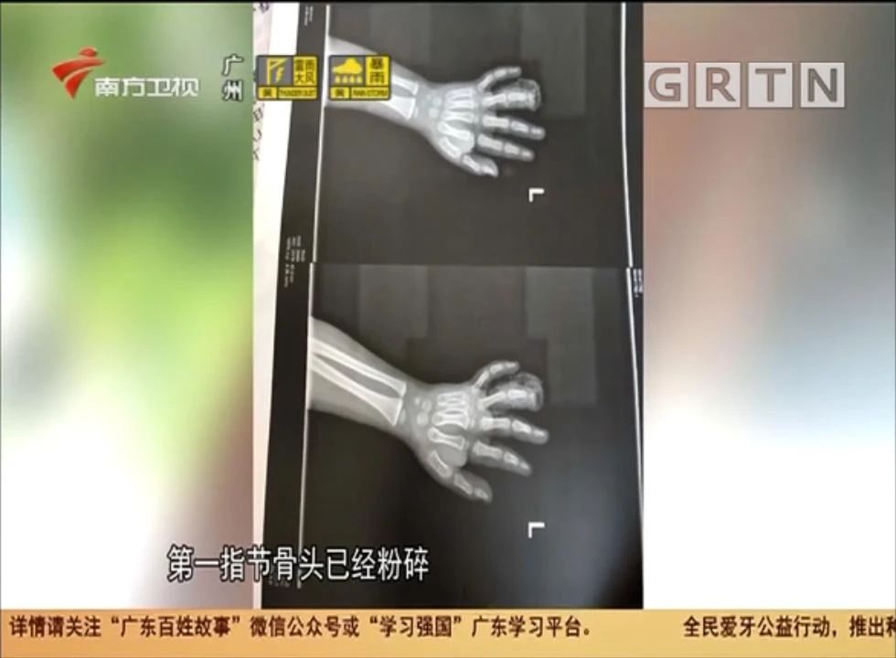 健身【心疼】4岁男童被这种器械夹伤，导致手指截肢！很多小区都有...