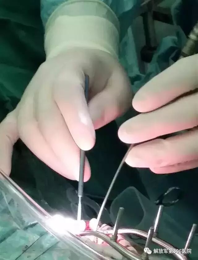 剥离子怎么使用指尖巧弄琅玕影---显微神经外科剥离子_https://www.jmylbn.com_新闻资讯_第23张
