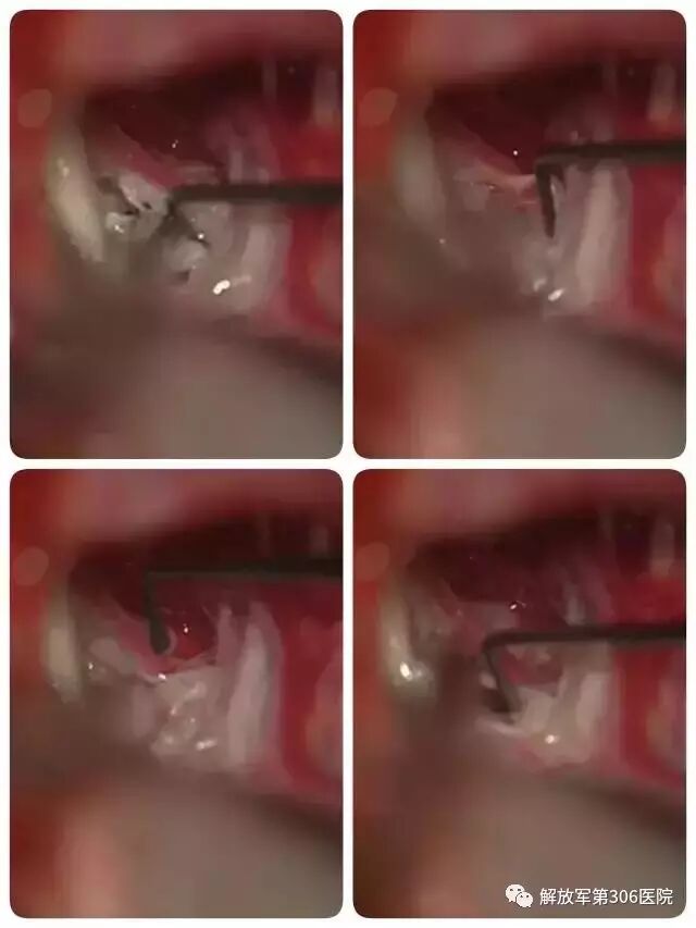 剥离子怎么使用指尖巧弄琅玕影---显微神经外科剥离子_https://www.jmylbn.com_新闻资讯_第22张