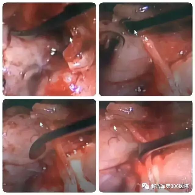 剥离子怎么使用指尖巧弄琅玕影---显微神经外科剥离子_https://www.jmylbn.com_新闻资讯_第11张