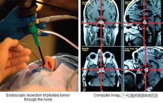 剥离子怎么使用指尖巧弄琅玕影---显微神经外科剥离子_https://www.jmylbn.com_新闻资讯_第1张