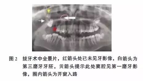 上颌第一磨牙全牙进入上颌窦如何处理