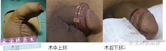包皮自动切除环怎么用目前最常用的3种包皮环切手术方式与各自优缺点_https://www.jmylbn.com_新闻资讯_第6张