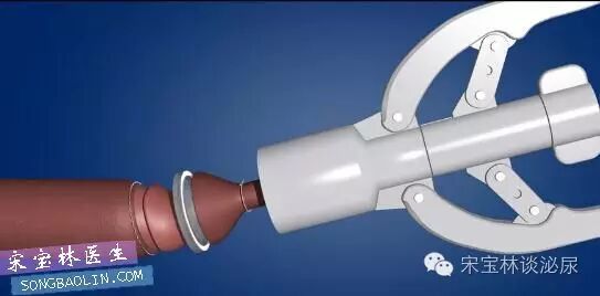 包皮自动切除环怎么用目前最常用的3种包皮环切手术方式与各自优缺点_https://www.jmylbn.com_新闻资讯_第9张