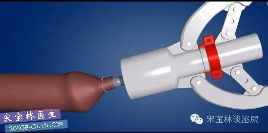 包皮自动切除环怎么用目前最常用的3种包皮环切手术方式与各自优缺点_https://www.jmylbn.com_新闻资讯_第8张