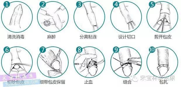 包皮自动切除环怎么用目前最常用的3种包皮环切手术方式与各自优缺点_https://www.jmylbn.com_新闻资讯_第4张