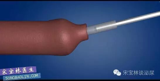 包皮自动切除环怎么用目前最常用的3种包皮环切手术方式与各自优缺点_https://www.jmylbn.com_新闻资讯_第7张