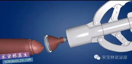 包皮自动切除环怎么用目前最常用的3种包皮环切手术方式与各自优缺点_https://www.jmylbn.com_新闻资讯_第10张