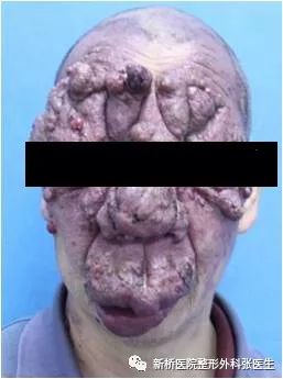 血管瘤不可小视之一:草莓状血管瘤