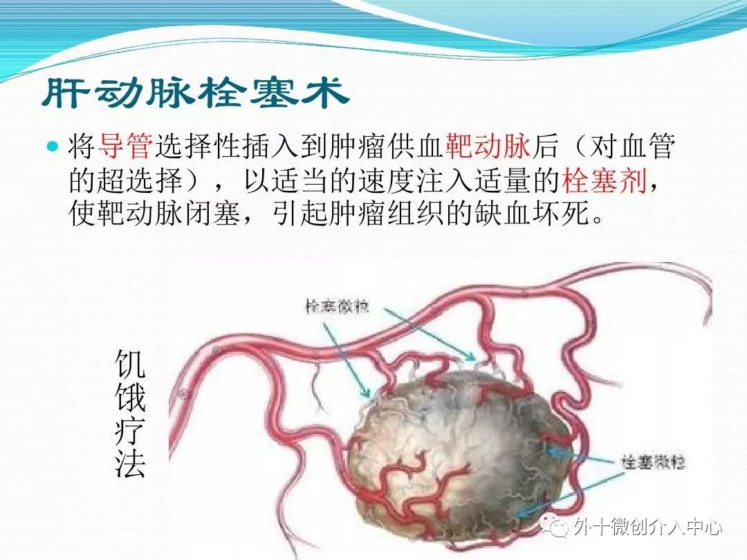 肝癌治疗的首选--肝动脉化疗栓塞术