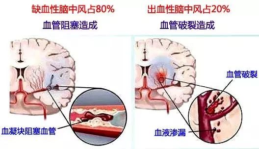 偏头痛与病人术后患缺血性脑中风以及再入院的风险有关