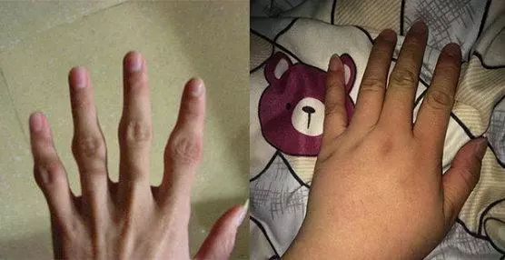 脊髓损伤 1,怕冷:类风湿患者的手指对寒冷特别敏感,一遇冷水很容易发