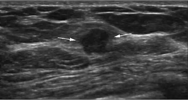 穿刺枪怎么升级乳腺穿刺术（三）_https://www.jmylbn.com_新闻资讯_第58张