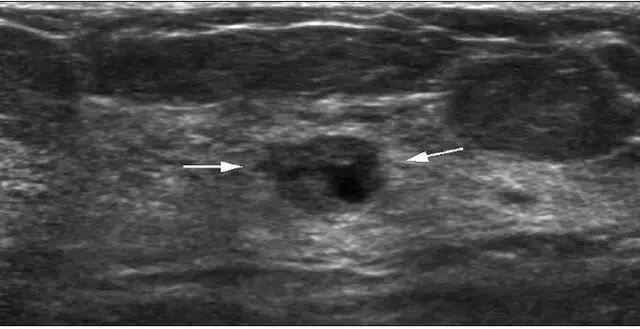 穿刺枪怎么升级乳腺穿刺术（三）_https://www.jmylbn.com_新闻资讯_第59张