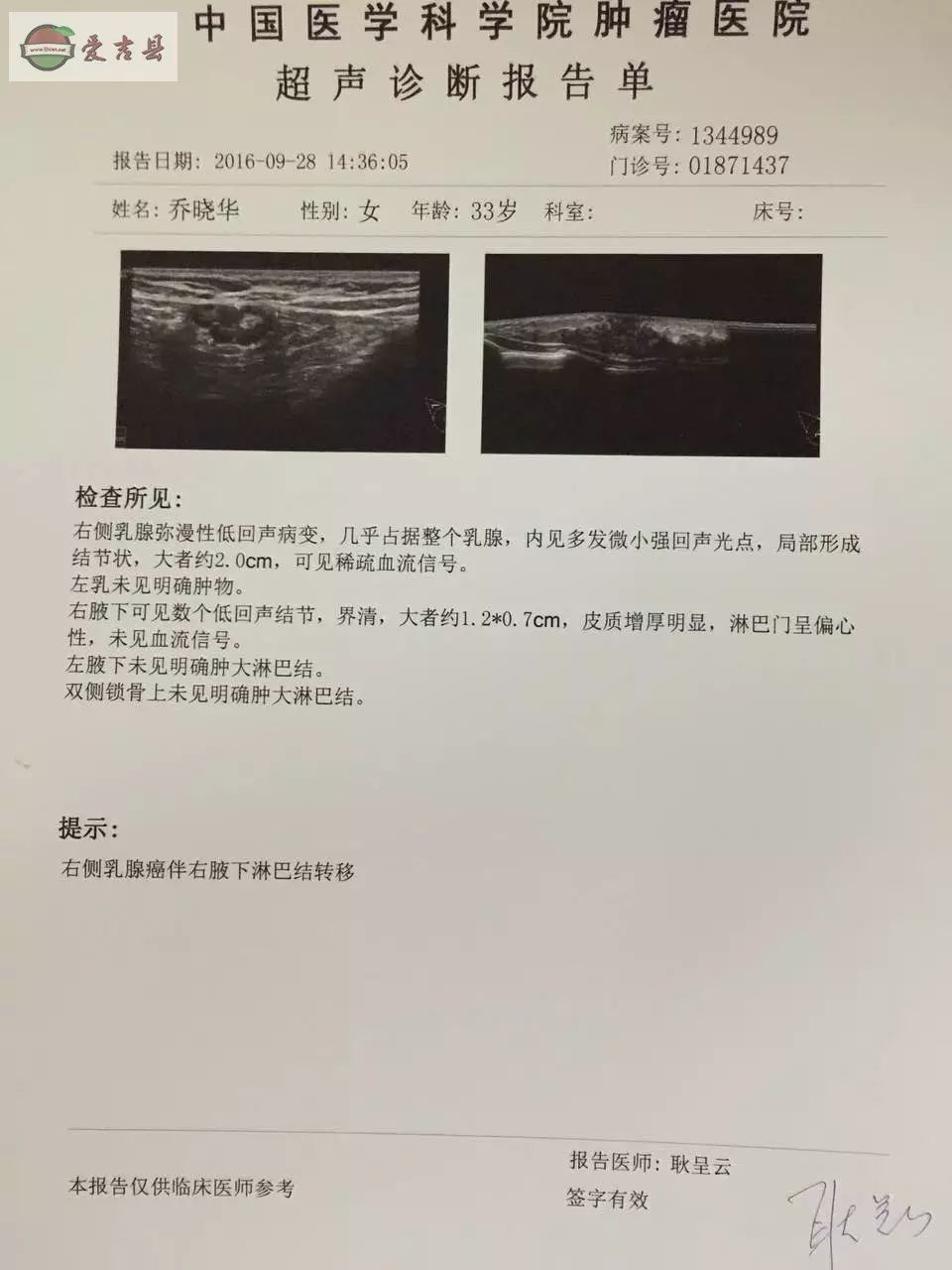 ①超声诊断报告:右侧乳腺癌变,右腋下淋巴结转移; ②乳腺mr扫描影像