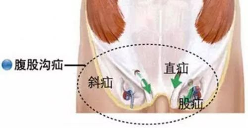 李主任解释说,疝气即人体内某个脏器或组织离开其正常解剖位置,通过