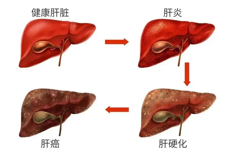 728世界肝炎日遏制沉默的杀手时不我待