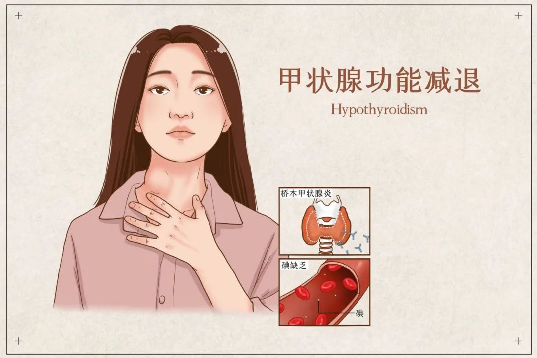 摄图网_401804056_甲状腺功能减退医疗插画(企业商用).jpg