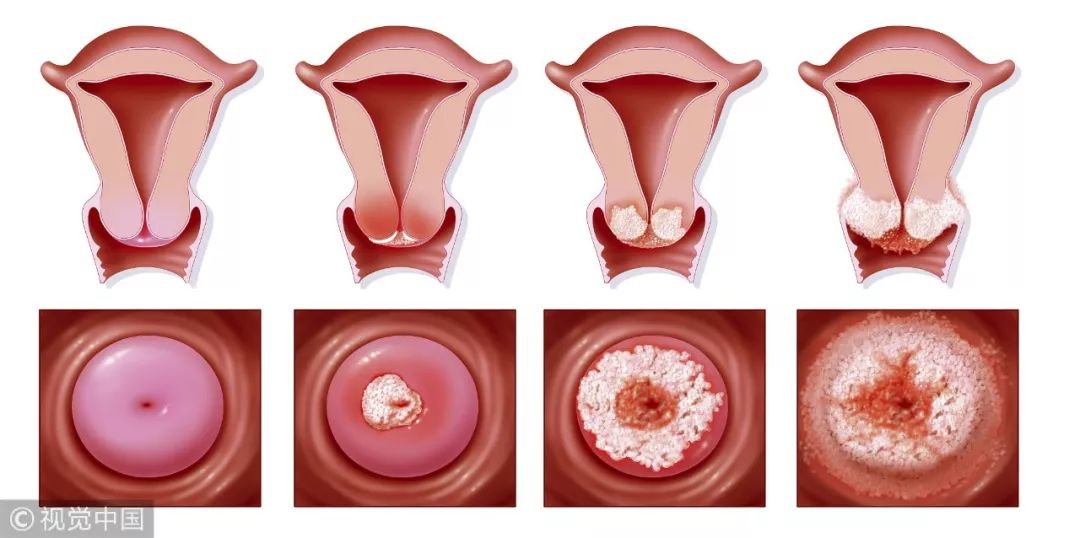宫颈癌的四个阶段 视觉中国