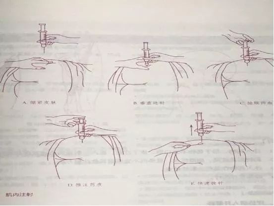 超详细 | 臀大肌注射出现硬结怎么"破"