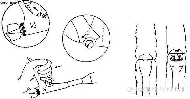 医用缝合扣怎么用[手术频道]外科常用手术器械及使用方法。（聂邯洛医师推荐17-08-10）_https://www.jmylbn.com_新闻资讯_第43张
