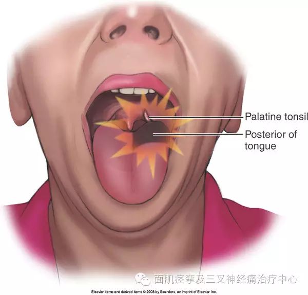 30岁以前人群几乎没有舌咽神经痛,除非有多发性硬化,所有这些患者需要