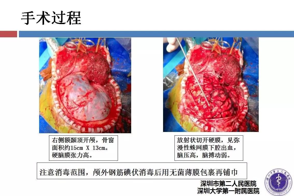 钢筋致穿透性颅脑损伤病例分享一例丨颅脑创伤神经重症病例周刊第27期