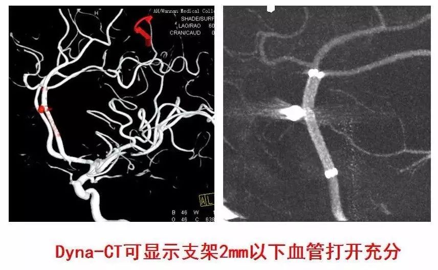 李真保教授enterprise支架在颅内动脉瘤中的应用