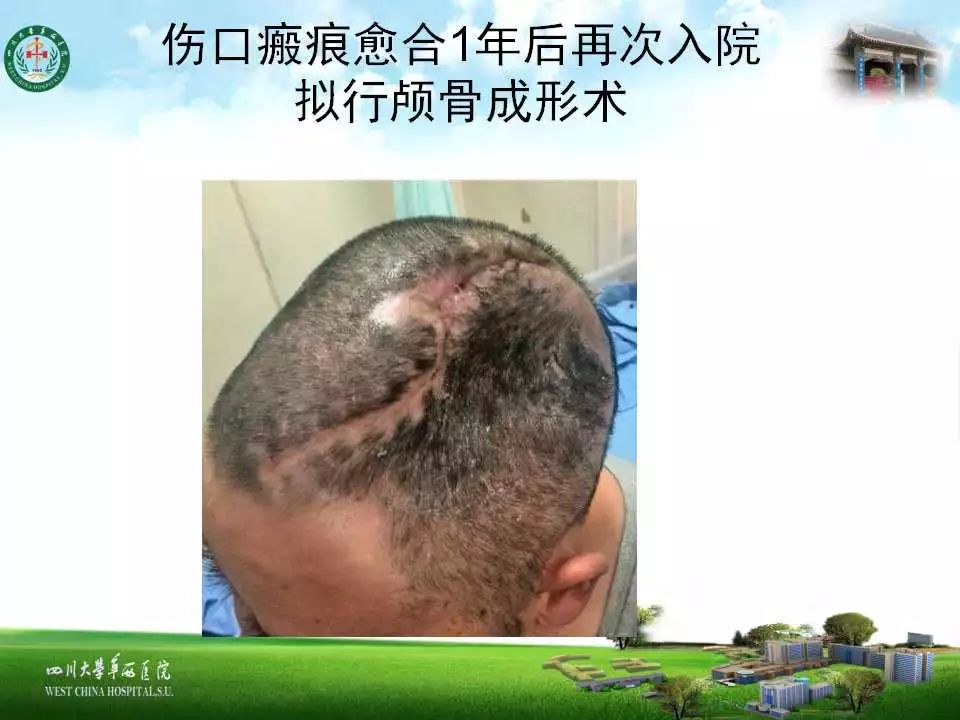 头皮扩张术在颅骨成形术中的应用一例分析