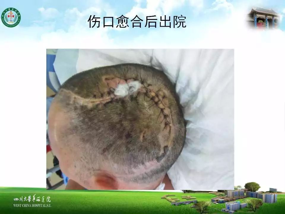 头皮扩张术在颅骨成形术中的应用一例分析