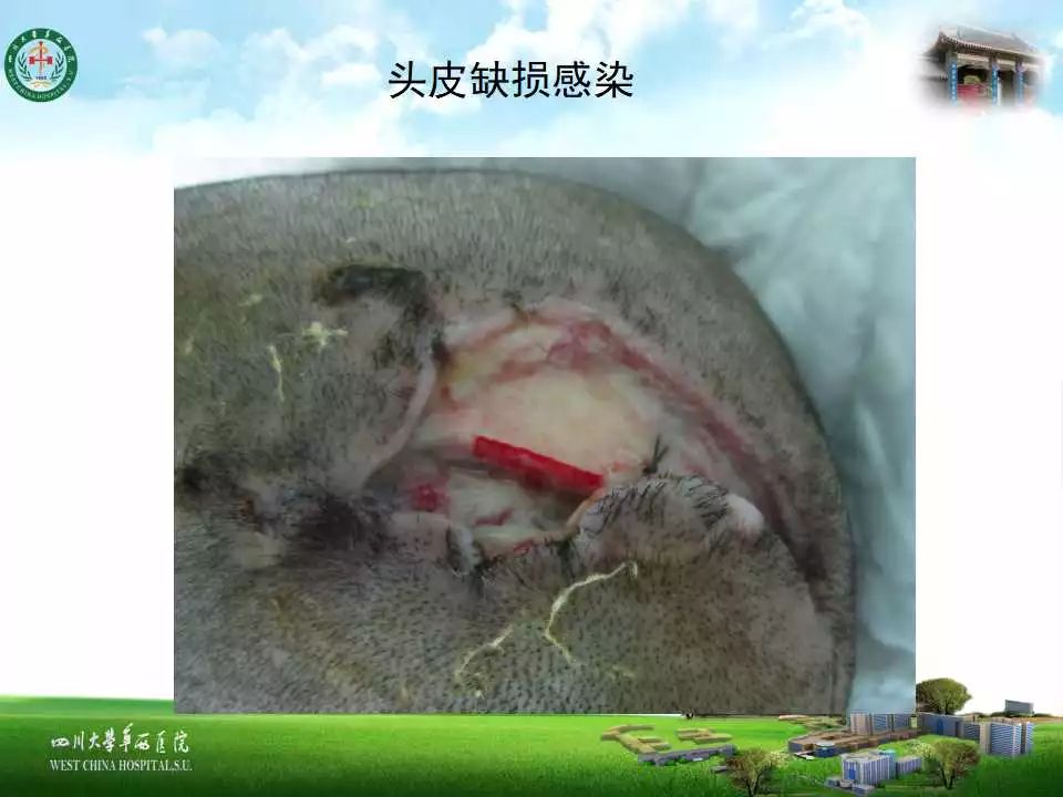 头皮扩张术在颅骨成形术中的应用一例分析