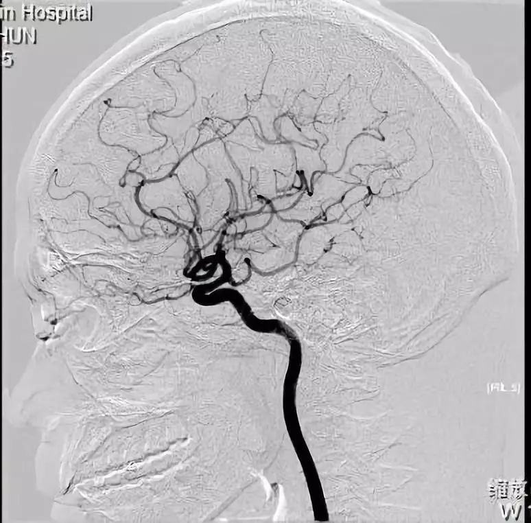 影像特点:入院后予完善头颅dsa检查提示左侧大脑后动脉p1-p2段大动脉