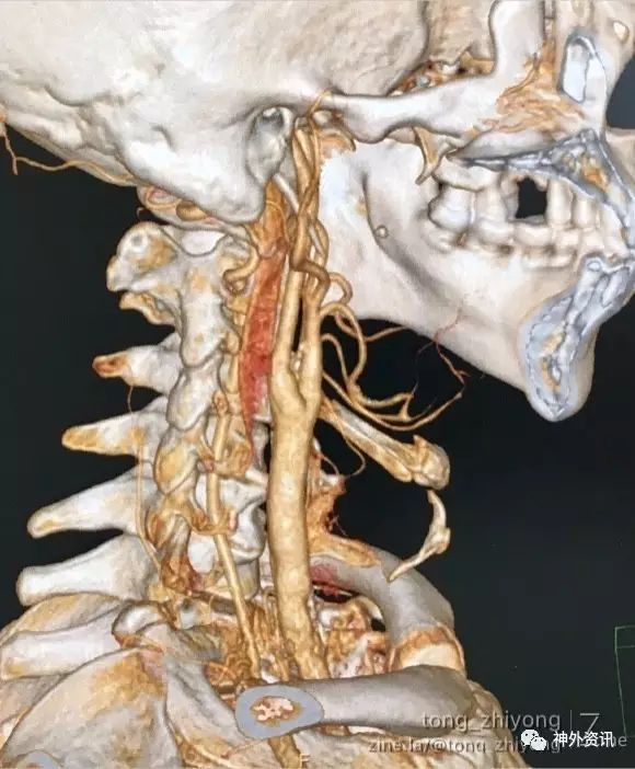 病例分享 80mm超长右侧颈动脉硬化斑块切除术