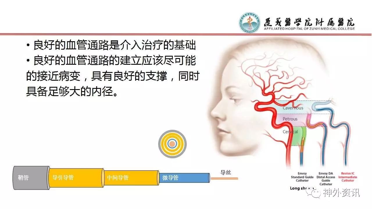 冉启山教授envoyda在建立血管通路中的临床体会