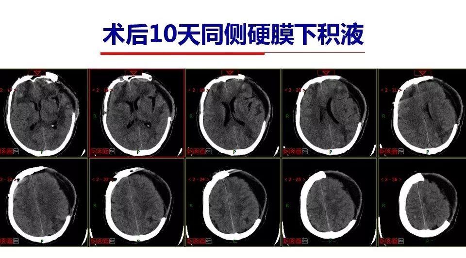 dc术后硬膜下积液合并脑内积水的相关因素及处理颅脑创伤神经重症病例