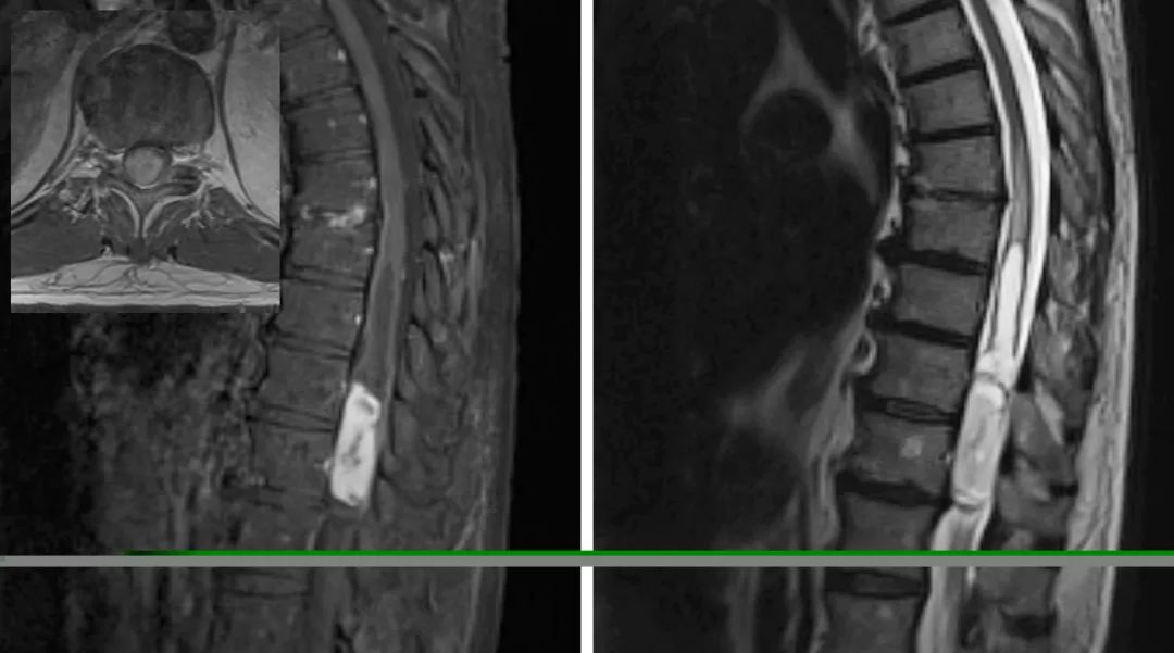 脊髓髓内肿瘤手术策略与技巧theneurosurgicalatlas全文翻译