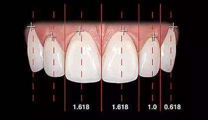 上中,侧切牙,尖牙宽度比例基本符合黄金分割比即1.618:1:0.