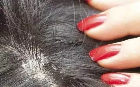 分析头皮屑形成的原因，笛梵产品如何有效去头皮屑？
