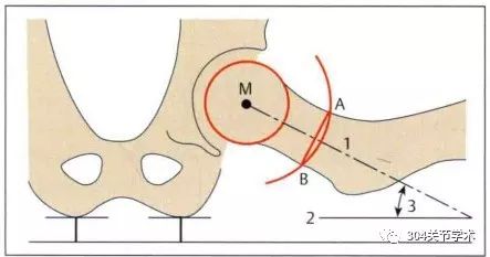 图1-a),拍片示意图见图1-b,x线图见图1-c,两线夹角即为股骨颈前倾角