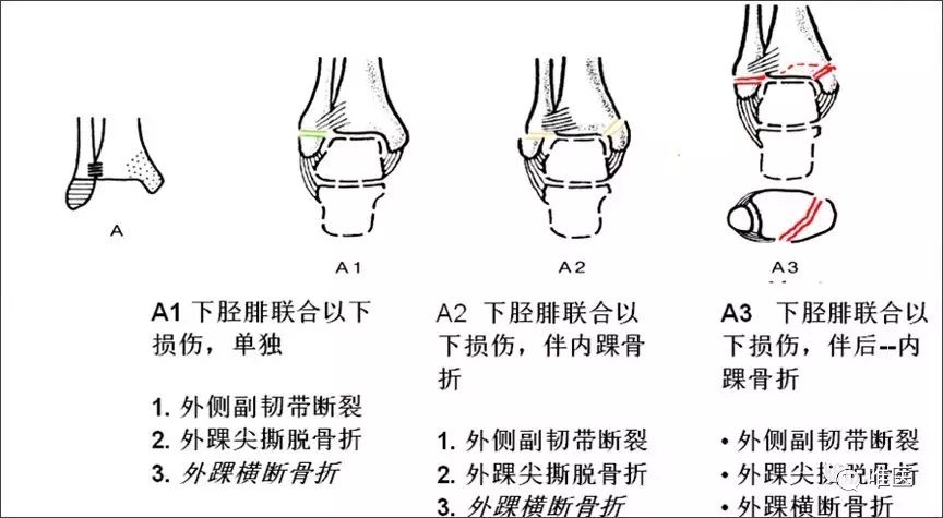 张健等认为后方pilon 骨折是介于典型高能量轴向暴力所致pilon 骨折与