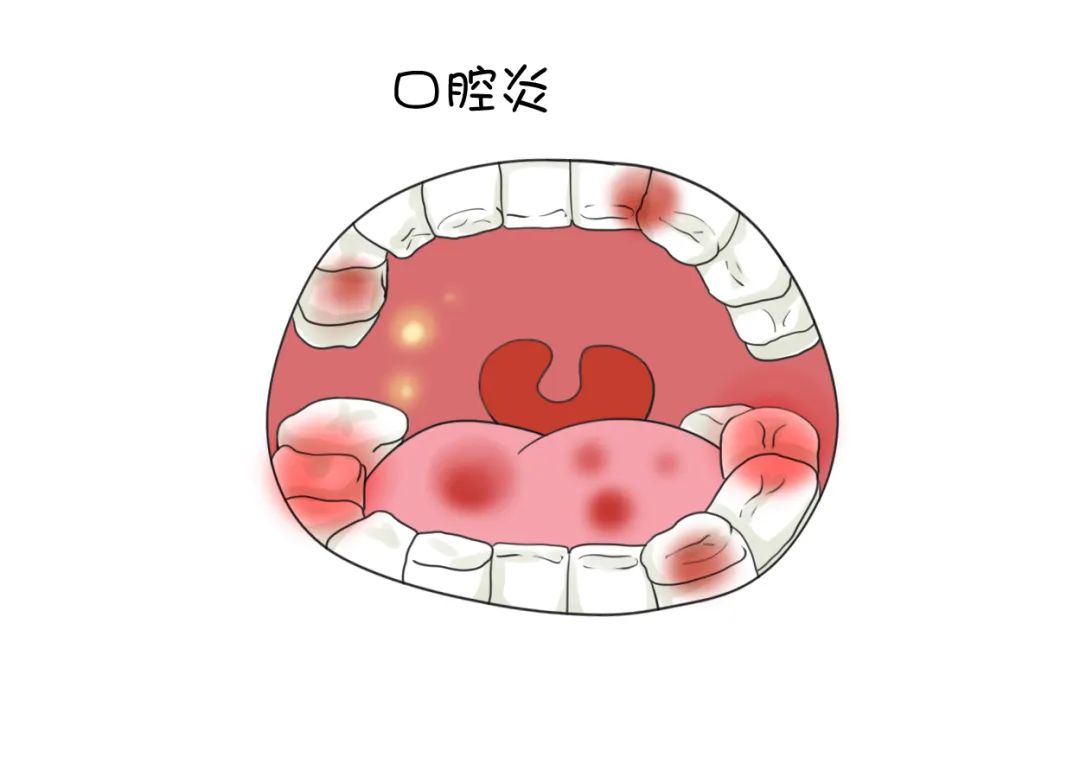 史上最全汇总乳腺癌患者的口腔问题请这样处理