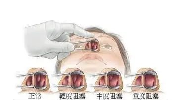 耳鼻喉镜篇鼻甲肥大