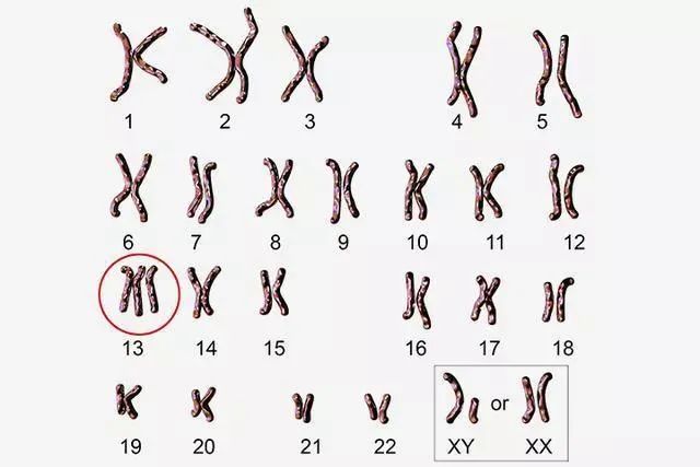 染色体病之13三体综合征