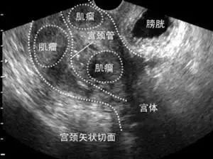 子宫肌瘤位置分类图) 所以,当我们拿到超声报告时,需要关注子宫肌瘤的