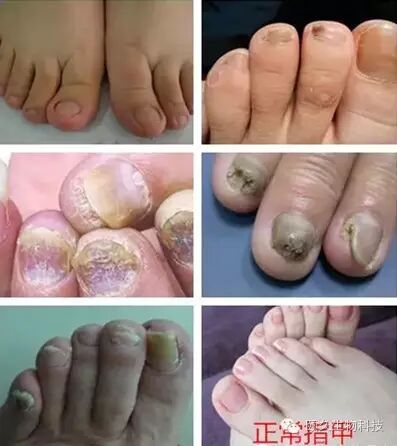 治疗灰指甲有诀窍！