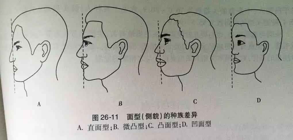 从左至右: 直面型,微凸型,凸面型,凹面型